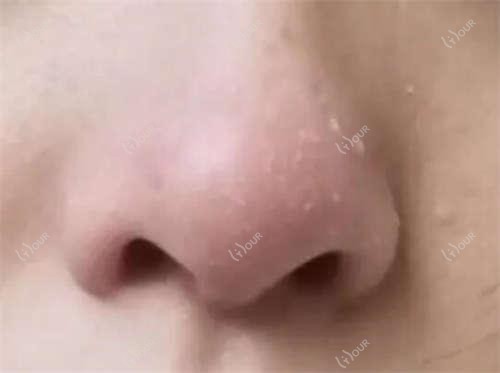 上海市医大眼科手术费用揭秘:近视全飞秒约1W+ 近视半飞秒及白内障超声乳化均1W+起