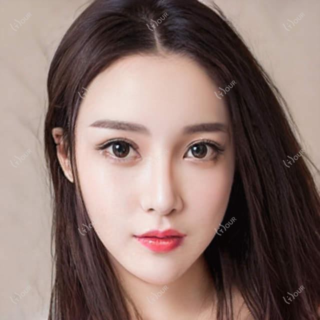 济南脉冲光去眼角细纹大概需要多少钱?自体脂肪去眼角细纹1千元左右