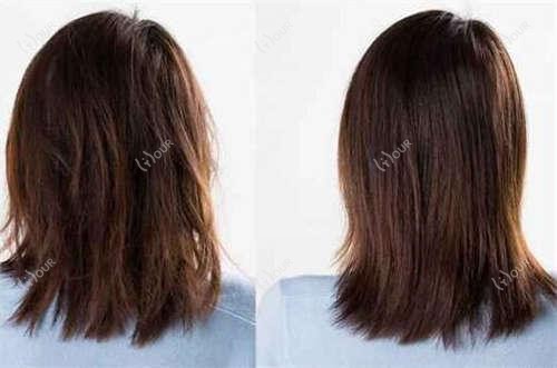 高颅顶重塑潍坊体验：花4800元值得吗？当地哪位医生技术佳？