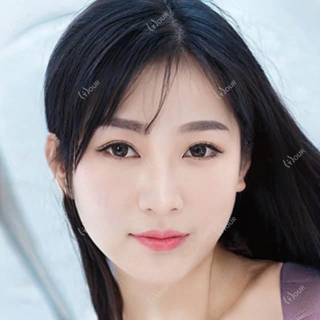 扬州眼周填充选胶原蛋白还是玻尿酸?3k和6k价位疗效对比解析
