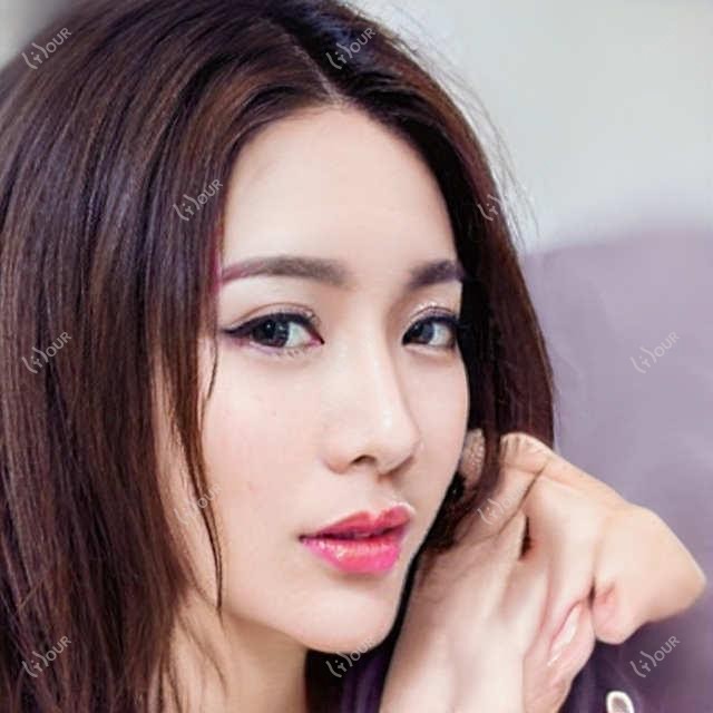 宿迁桃花眼和双眼皮怎么选？桃花眼9800值不值？