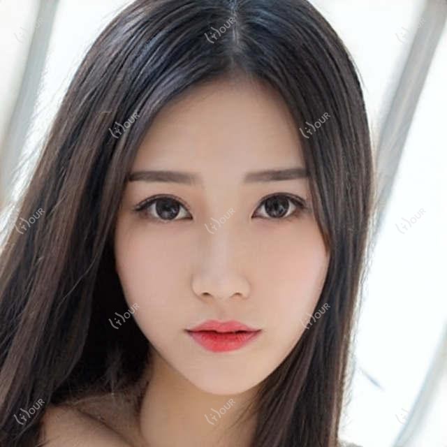 玻尿酸丰面颊：5800元疗效如何？贵阳这几家医院口碑不错！